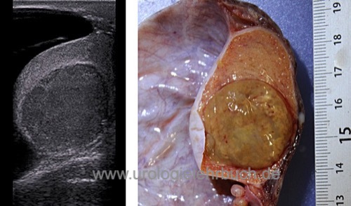 Abbildung Leydigzell-Tumor in der Sonographie und in der Makroskopie