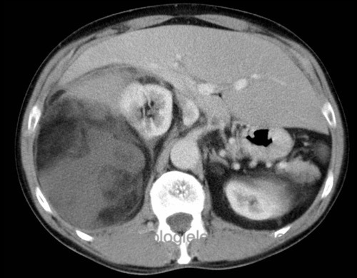 Abbildung CT-Abdomem: gut differenziertes Liposarkom.