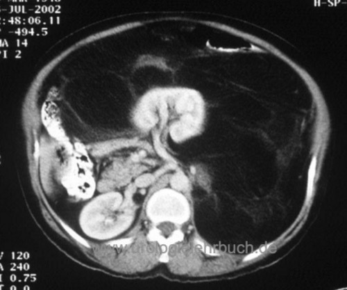 Abbildung CT-Abdomem: fortgeschrittenes retroperitoneales Liposarkom mit Verdrängung von linker Niere und Darm.