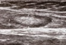 Sonographie einer gutartigen Lymphadenopathie (lipomatöse Lymphknotenvergrößerung) Sonographie gutartige Lymphadenopathie