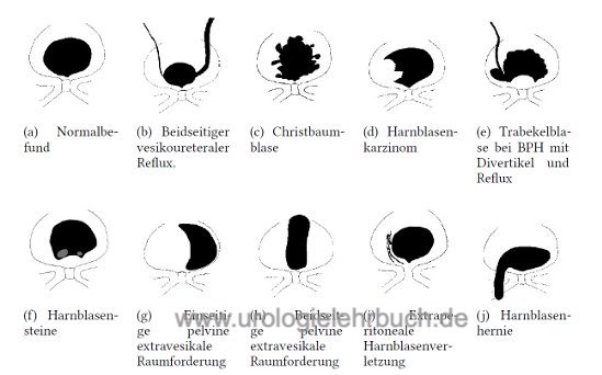 Abbildung Differentialdiagnose der Miktionszysturethrographie schematisch