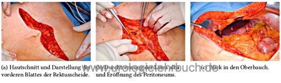 Technik der medianen Laparotomie Abbildung Technik der medianen Laparotomie