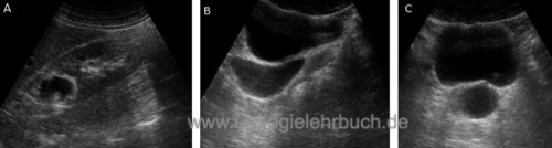 Abbildung Sonographie Megaureter des Oberpolsystems