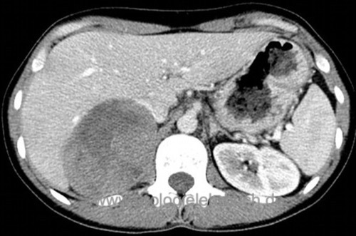 Abbildung CT eines Nebennierenrindenkarzinoms