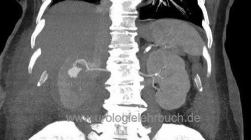 Abbildung Aneurysma spurium nach Nierenteilresektion rechts in der CT