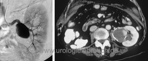 Abbildung CT und Angiographie eines Nierenarterienaneurysmas