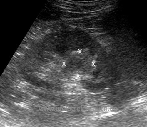 Sonographie Harnleiterkarzinom und Nierenbeckenkarzinom