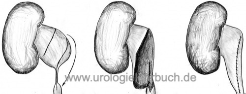 Nierenbeckenplastik nach Culp-Deweerd: mit Hilfe eines Lappens aus dem Nierenbecken kann eine narbige Striktur bis zum proximalen Harnleiter überbrückt werden.