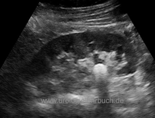 Sonographie Nierenbeckenstein Schallauslöschung Ultraschall