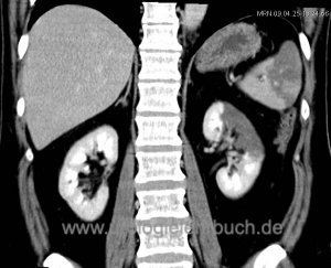 Abb. CT eines partiellen Niereninfarkts
