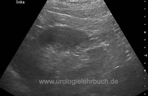 Abb. Kortexnarbe in der Sonographie nach Niereninfarkt