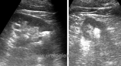 Sonographie Nierenstein Ultraschall