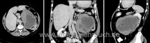 Abbildung Großes Nierensarkom im CT-Abdomen