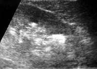 Sonographie eines Nierensteins Sonographiebild eines Nierensteins