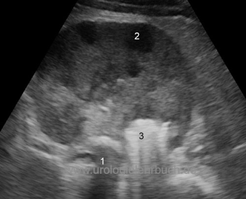 Sonographie der Niere mit großem Nierenabszess