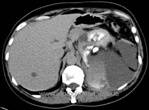 Abbildung CT eines Urinoms nach Nierenteilresektion links