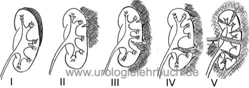Abbildung AAST-Einteilung der Schwere des Nierentraumas