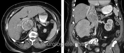 Abbildung Großer Cavathrombus bei einem rechtsseitigen Nierenzellkarzinom