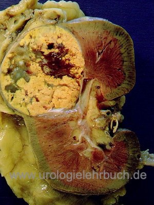 Abbildung Operationspräparat eines konventionellen Nierenzellkarzinoms: typisch ist die gelb-braune Schnittfläche