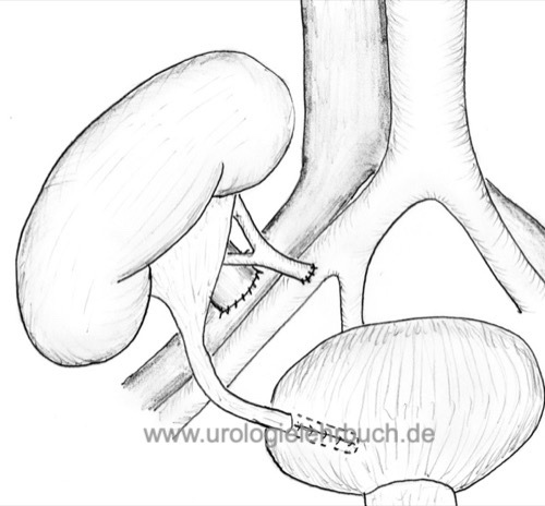 Schematische Darstellung einer rechtsseitigen Nierentransplantation mit Gefäßanastomose an den Vasa iliaca