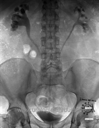 Abbildung Urogramm bei retroperitonealer Fibrose (Ormond Erkrankung)