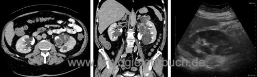 Abbildung CT-Abdomen mit multiplen parapelvinen Zysten im Sinus renalis mit Elongation des Nierenkelchsystems ohne Harnstau. In der Sonographie können parapelvine Nierenzysten leicht als Harnstau interpretiert werden.