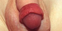 Paraphimose Paraphimose Schemazeichung