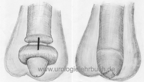 Operation einer Paraphimose