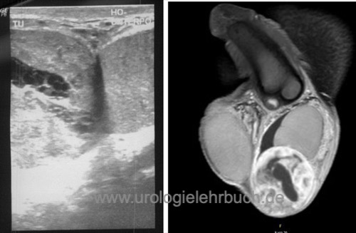 Sonographie und MRT eines paratestikulärem Rhabdomyosarkom