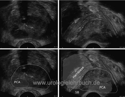 TRUS transrektaler Ultraschall der Prostata mit Prostatakarzinom
