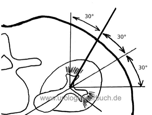 Punktion Nierenbeckenkelchsystem PCN PNL perkutane Nephrolithotomie Nephrolithiasis