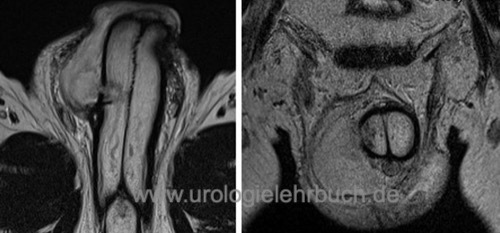 Abbildung MRT einer Penisfraktur