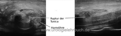 Abbildung Sonographie einer Penisfraktur