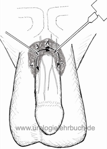 Abbildung Peniswurzelblock: mit Hilfe von zwei Injektionen wird das Lokalanästhetikum zirkulär um den Penisschaft injiziert