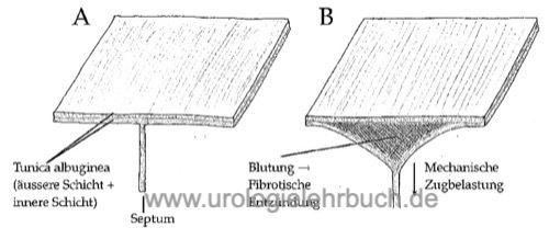 Abbildung Pathogenese der Induratio penis plastica durch Mikrotraumata