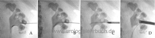 Radiologische Dokumentation des Zugangs für eine Mini-PNL bei einem Ausgussstein rechts (Aufnahmen in Bauchlage)