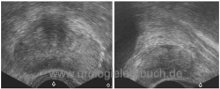 Transrektaler Ultraschall der Prostata vor Prostatabiopsie