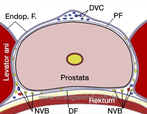 Abbildung Faszienumhüllung der Prostata DVC=dorsaler Venenplexus (Santorinii). Endop. F.=endopelvine Faszie (viszerales Blatt bedeckt die Prostata, parietales Blatt auf dem M. levator ani). PF=Prostatafaszie. DF=Denonvilliers-Faszie. NVB=Nerven-Gefäß-Bündel mit Ästen des N. cavernosus.