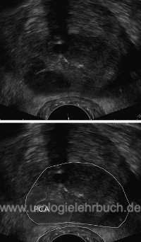 Abbildung TRUS eines Prostatakarzinoms