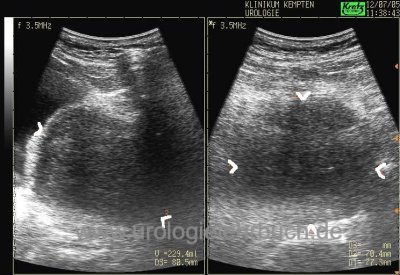 prostata normale größe sonographie