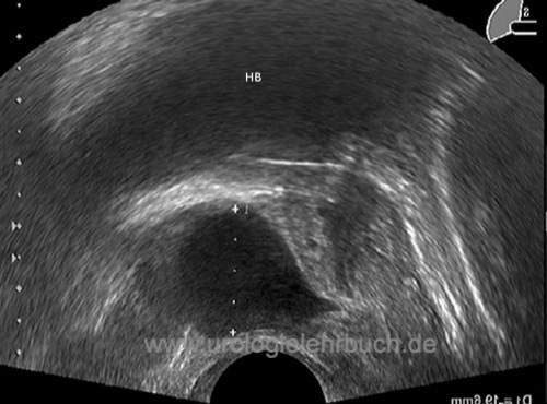 Transrektale Sonographie einer Prostatazyste