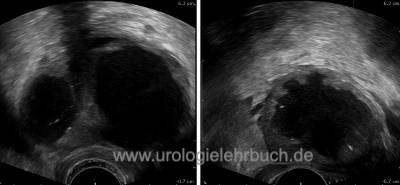 chronische abakterielle prostatitis behandlung