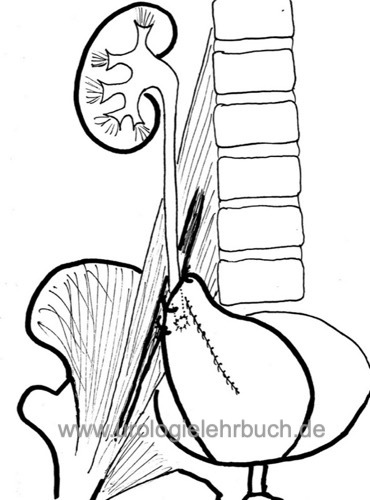 Harnleiterreimplantation mit Psoas-Hitch-Technik