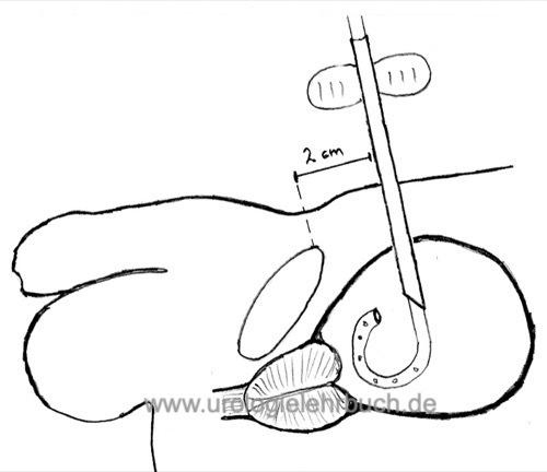 Abbildung Anlage eines suprapubischen Dauerkatheters mit Hilfe eines Hohltrokars