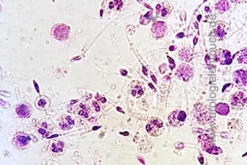 Abbildung Pyospermie: zahlreiche Leukozyten im Ejakulat.