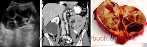 Großes zystisches Nierenzellkarzinom (pT2bG2) in der Sonographie, CT und als Präparat
