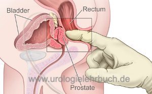 Abb. rektale Untersuchung mit Prostata