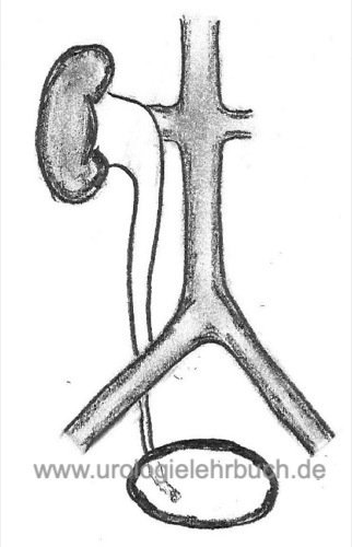 Abbildung retroiliakaler Ureter