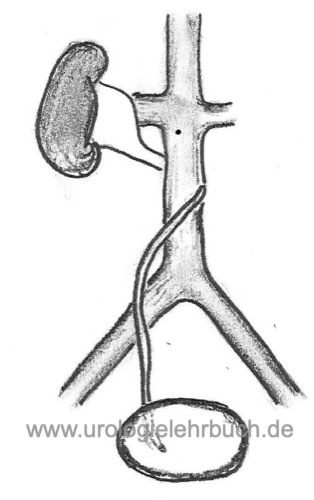 fig. Schematische Zeichnung eines retrokavalen Ureters