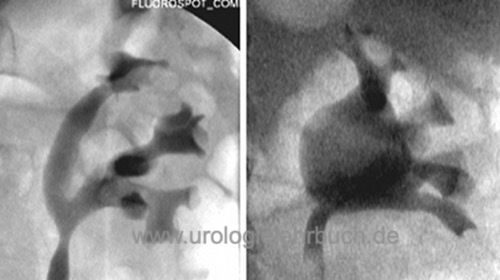 Abb. retrograde Pyelographie von ampullärem und dendritischen Nierenbecken